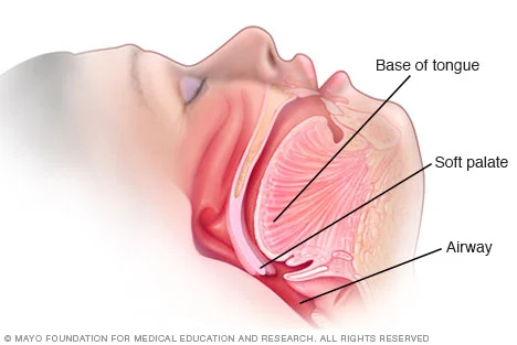 cartoon diagram of snoring and apnea mayo foundation